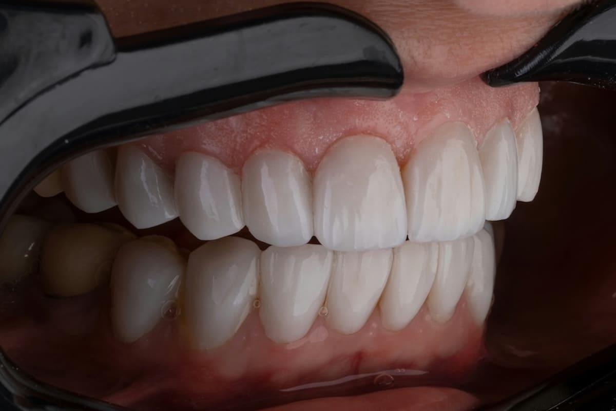 ¿Quieres conocer soluciones reales a un implante dental sin hueso? Entonces este artículo es para ti. Dentista en Palma de Mallorca.