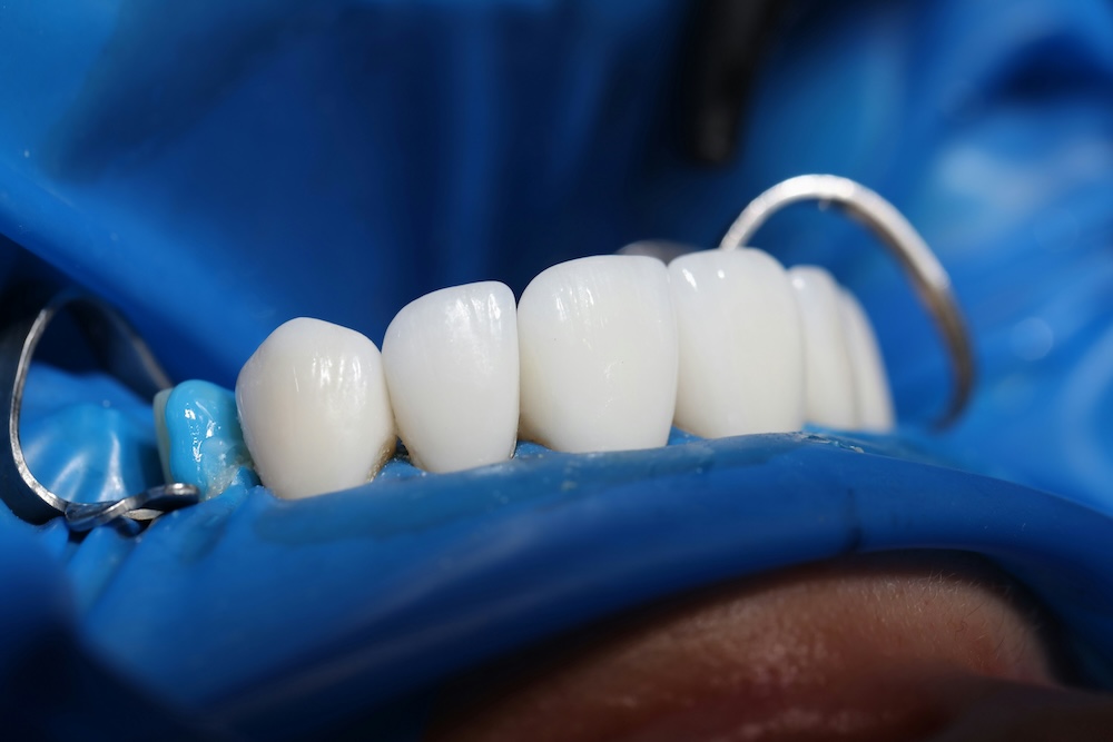 ¿Quieres saber qué son y cuándo son recomendables las prótesis dentales? En este artículo te lo contamos. Clínica dental en Palma de Mallorca