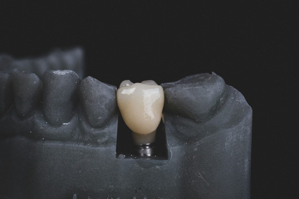 ¿Quieres saber qué son los implantes dentales y cuándo son la mejor opción? En este artículo te lo contamos. Clínica en Palma de Mallorca.