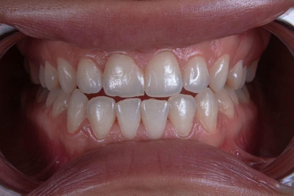Cuánto tarda un implante dental: fases, plazos reales y tiempos totales desde la primera visita hasta la corona definitiva. Guía clara para planificar el tratamiento.