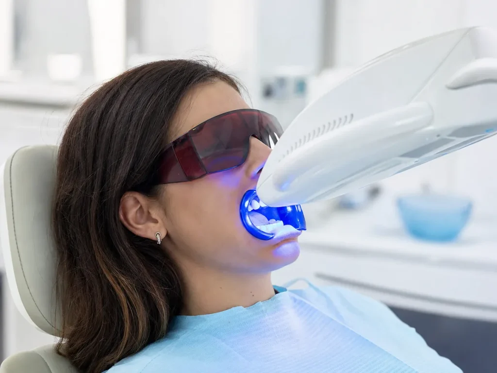 Blanqueamiento Dental en Casa o en Clínica: Cuál Elegir