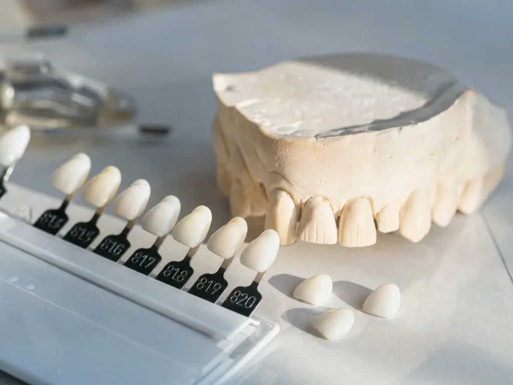 Cuánto Cuestan las Carillas Dentales en Mallorca
